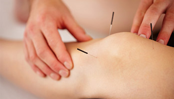 L'acupuncture dans le SII : une nouvelle option thérapeutique ?