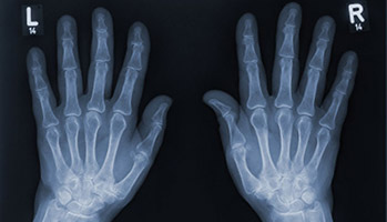 Arthrose&nbsp;: comment les patients g�rent-ils la douleur&nbsp;? 