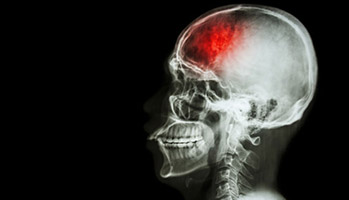 AVC isch�mique&nbsp;: le duo clopidogrel-aspirine r�duit le risque de r�cidive