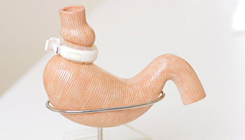 SOPK&nbsp;: la chirurgie bariatrique am�liore la fertilit� en cas d'ob�sit�