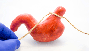 La chirurgie bariatrique pour les diab�tiques de type 2 ob�ses