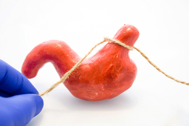 Efficacit  long terme de la chirurgie bariatrique chez les adolescents obses