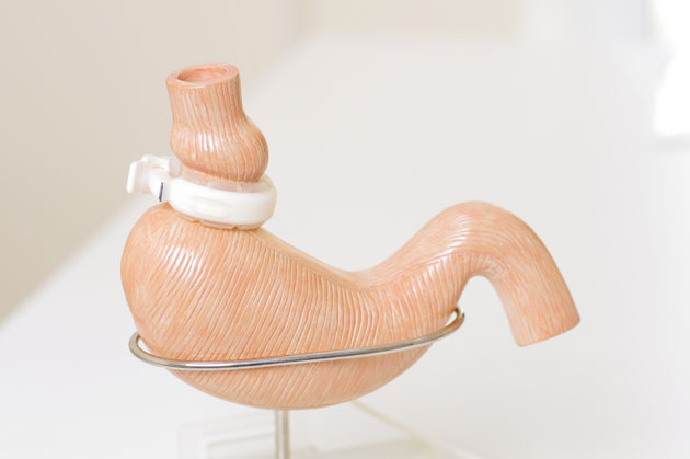 Et pourquoi pas la chirurgie mtabolique chez les patients diabtiques de type 1 ?