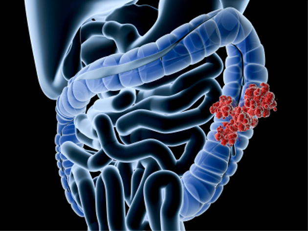 Valeur pronostique de linfiltrat lymphocytaire tumoral dans le cancer colique (CCR) de stade 3 trait en adjuvant par FOLFOX : validation dune technique automatise utilisable en pratique clinique courante