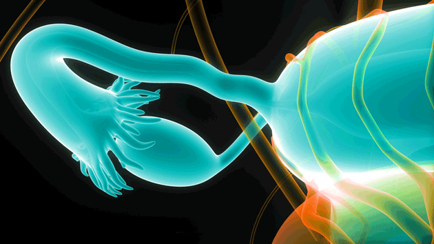 PAOLA-1&nbsp;: L'olaparib en association avec le bevacizumab&nbsp;: un pas de g�ant en avant pour le traitement de premi�re ligne du cancer de l'ovaire