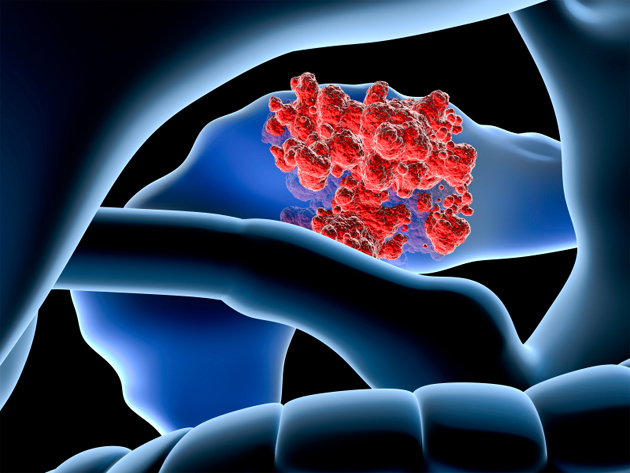 Tmozolomide vs tmozolomide + capcitabine dans les tumeurs neuroendocrines avances du pancras : rsultats de l'essai de phase III ECOG-ACRIN E2211