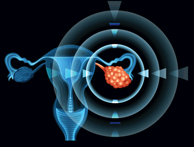 R&eacute;sultats de survie globale &agrave; sept ans dans SOLO-1&nbsp;: un essai 