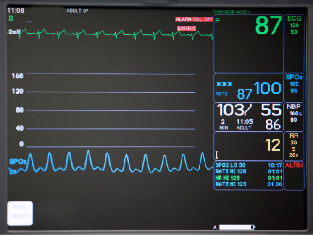 Risque de p&eacute;ricardite aigu&euml; apr&egrave;s une ablation de fibrillation atriale&nbsp;: int&eacute;r&ecirc;t de la colchicine