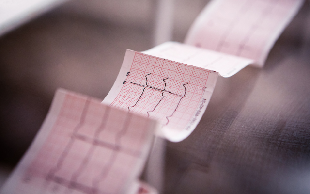 Repenser la fibrillation atriale : adopter un contrle prcoce du rythme au-del des symptmes