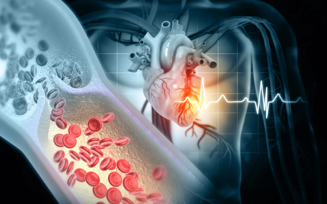 Obésité et insuffisance cardiaque : ce qu'il faut savoir sur les nouvelles stratégies de prise en charge