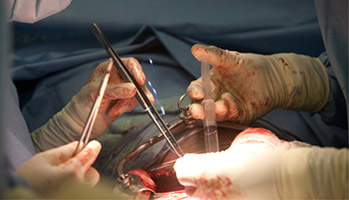 Transplantation h�patique&nbsp;: la technologie contre la p�nurie de greffons