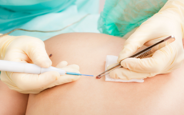 Biomarqueurs dans le m&eacute;lanome en pratique clinique