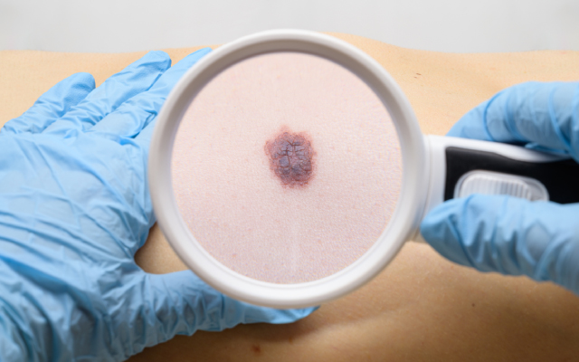 A la uneÉtude en vie réelle comparant la tolérance et l'efficacité des inhibiteurs de la voie <i>hedgehog</i> parmi 330 patients atteints de carcinome basocellulaire avancé