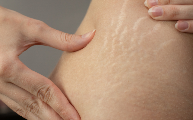 L'utilisation du dupilumab pour la dermatite atopique est associée à un risque réduit de cancers profonds et de carcinomes cutanés en comparaison aux traitements systémiques classiques et aux patients non traités