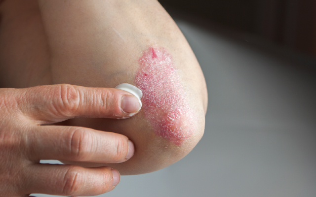 Quid des questionnaires de dpistage d'une spondyloarthrite chez des sujets ayant un psoriasis, une uvite ou une MICI ?