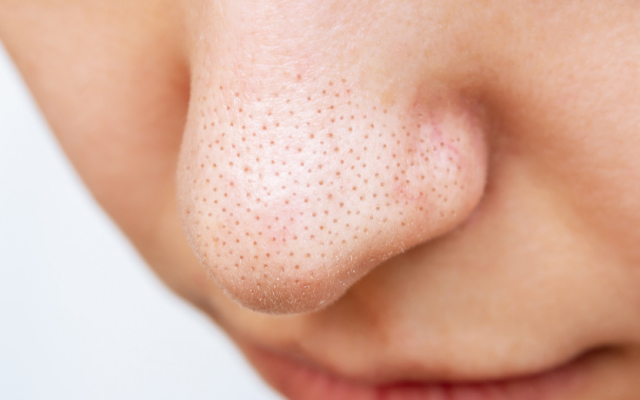 Efficacit&eacute; et tol&eacute;rance d'un inhibiteur de <i>Heat Shock Protein</i> 90 (HSP 90) au cours de l'hidrad&eacute;nite suppur&eacute;e&nbsp;: essai en double aveugle