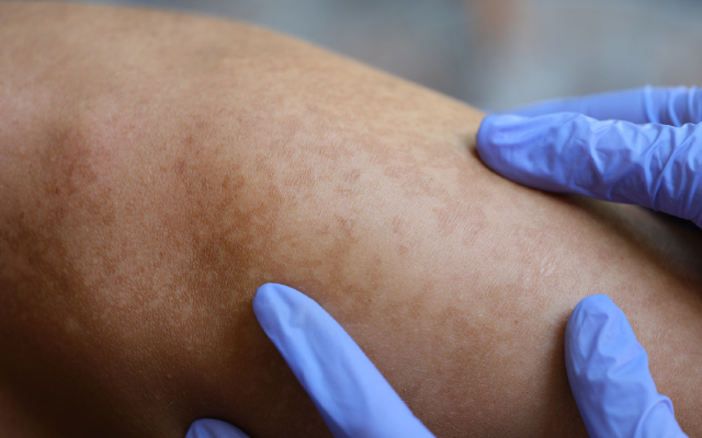 Risque d'vnements cardio-vasculaires majeurs (MACE) et d'accidents thrombo-emboliques veineux chez les patients avec psoriasis et/ou rhumatisme psoriasique sous anti-TNF, anti-IL-17 ou anti-IL-23