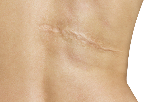 Le r&ocirc;le des lymphocytes T et de la voie OX40 dans la dermatite atopique