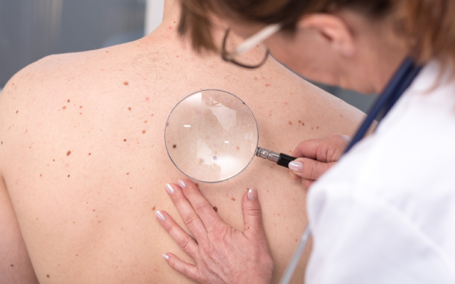 La survie à 1 an des biothérapies dans l'hidradénite suppurée est meilleure chez les patients bio-naïfs et en cas de chirurgie concomitante