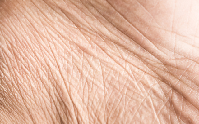 Facteurs pr&eacute;dictifs de r&eacute;ponse au traitement par corticoth&eacute;rapie orale dans la pelade&nbsp;: une &eacute;tude r&eacute;trospective