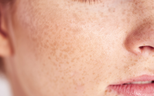 Intérêt des GLP-1RA dans les dermatoses inflammatoires chroniques : un effet immuno-régulateur allant au-delà de la réduction pondérale