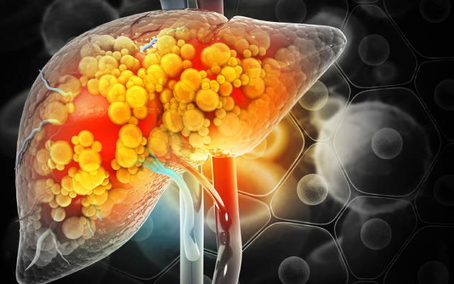 Un nomogramme pour prédire la survie globale des patients âgés porteurs d'un cancer du pancréas non opérés