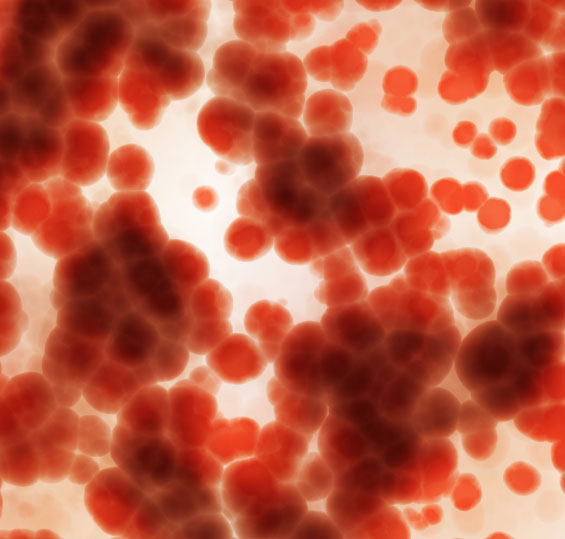 Une m�ta-analyse montre que le ruloxitinib diminuerait le risque de thrombose chez les patients atteints de polyglobulie de Vaquez et/ou de my�lofibrose