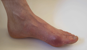 L'observance d�plorable dans la goutte inqui�te les acad�miciens