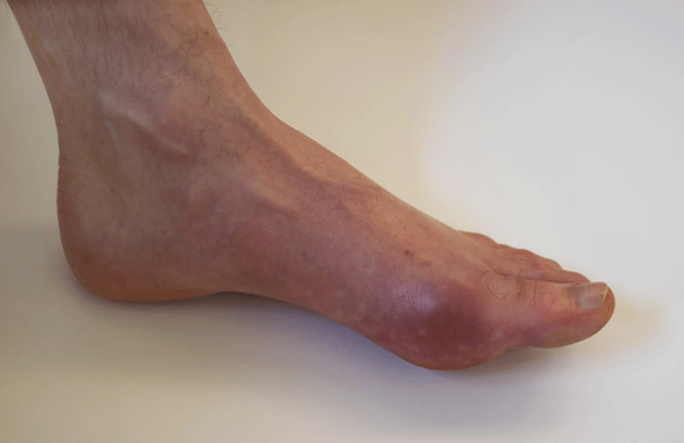 Traitement de la goutte par febuxostat ou allopurinol : quels risques cardiovasculaires ?