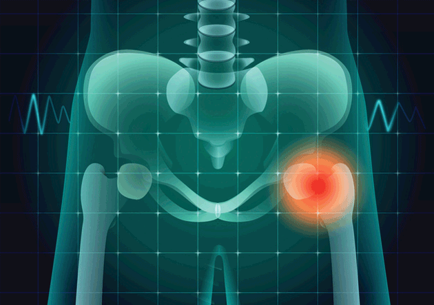 Risque de fracture sur proth&egrave;se totale de hanche&nbsp;: une fa&ccedil;on de sensibiliser les orthop&eacute;distes &agrave; l'ost&eacute;oporose&nbsp;?