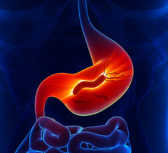Le traitement de linfection  Helicobacter pylori aprs Maastricht 5