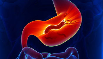 Cancer gastrique&nbsp;: l'incidence mondiale va augmenter avec 76% de cas attribuables &agrave; H. pylori