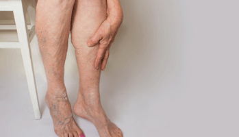 Thromboembolie veineuse : des diagnostics trop tardifs