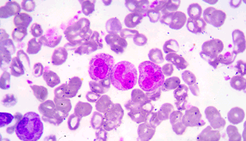 Leuc�mie p�diatrique&nbsp;: un marqueur pr�sent d�s la naissance