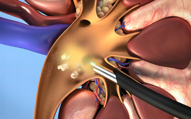 A la uneImpact des diur&eacute;tiques de l'anse sur l'&eacute;volution r&eacute;nale &agrave; long terme&nbsp;: une analyse <i>post hoc</i> de l'essai STOP-ACEi