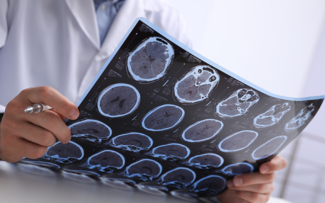 Les troubles neurologiques fonctionnels&nbsp;: une avanc&eacute;e dans leur d&eacute;cryptage physiopathologique