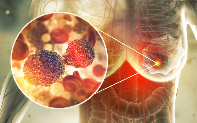 A la uneCLEOPATRA tombe : le T-DXd en ligne 1 des cancers du sein métastatiques HER2+ !