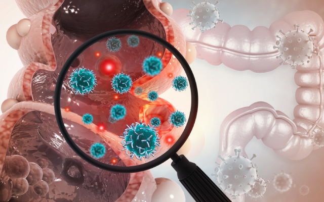 Faut-il toujours irradier les aires ganglionnaires en cas de réponse histologique complète (ypN0) après traitement médical néoadjuvant ? Éléments de réponse