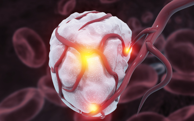 Tislelizumab plus chimiothrapie en traitement de premire ligne dans le cancer du nasopharynx rcidivant ou mtastatique : essai multicentrique de phase 3 RATIONALE-309