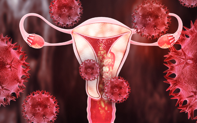 Cibler les récepteurs des glucocorticoïdes : une nouvelle cible dans le traitement du cancer de l'ovaire résistant aux platines