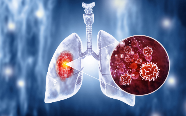 Le patritumumab deruxtecan&nbsp;: une phase 2 montrant son activit&eacute; en troisi&egrave;me ligne pour les cancers du poumon non &agrave; petites cellules EGFR mut&eacute;s, en progression apr&egrave;s osimertinib et chimioth&eacute;rapie &agrave; base de platine