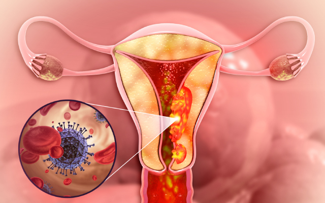 D&eacute;terminants pharmacologiques du rapport b&eacute;n&eacute;fice/risque du niraparib dans les cancers de l'ovaire&nbsp;: c'est mieux mais subsistent quelques questions en suspens...