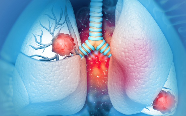Prolonger la survie des patients atteints de cancer du poumon à petites cellules : effet d'une maintenance post-induction par l'association lurbinectédine/atézolizumab