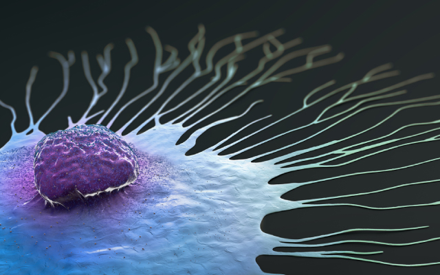 Cancers urologiques et polyarthrite rhumatoïde : un surrisque de cancer rénal notamment chez la femme