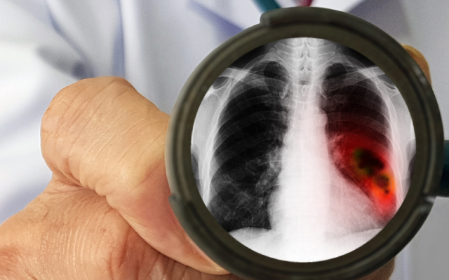 Facteurs de risques de r&eacute;cidive postop&eacute;ratoire pour les ad&eacute;nocarcinomes bronchiques de stade I op&eacute;r&eacute;s EGFR mut&eacute;s