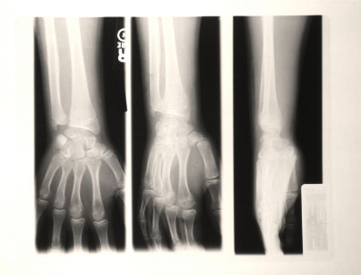 L'ost&eacute;opathie au m&eacute;thotrexate&nbsp;? Une cause de fracture &agrave; ne pas m&eacute;conna&icirc;tre