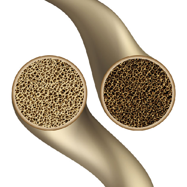 Association entre l'utilisation chronique d'inhibiteurs de la pompe &agrave; protons et la r&eacute;duction de la densit&eacute; et de la qualit&eacute; osseuse en fonction du sexe