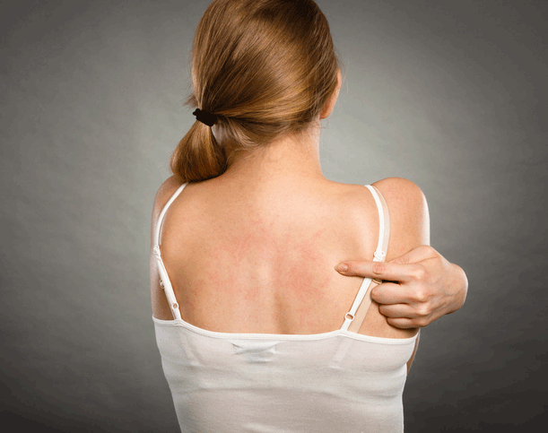 Guide pratique de l'International Eczema Council pour l'utilisation des JAK inhibiteurs dans la dermatite atopique