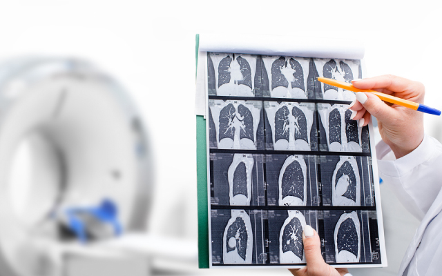 Peut-on connaître l'efficacité des dépistages par la réduction de la proportion de stades avancés ?