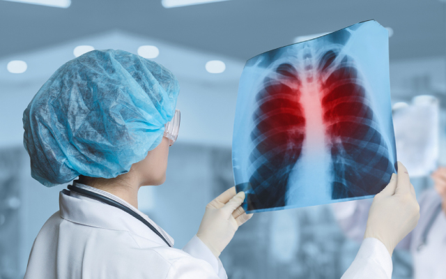 Le dupilumab confirme sa place dans la prévention des exacerbations de BPCO
